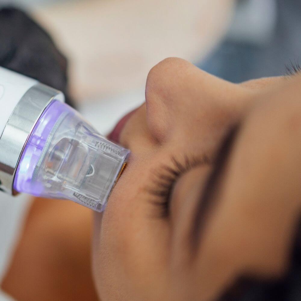 Nahaufnahme einer Frau bei einer Radiofrequenz Microneedling Behandlung im Kosmetikstudio in Wiener Neustadt für Hautstraffung und Hautverjüngung